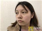 厦门欣医美面部吸脂情况好吗？吸脂真人案例分享+2021价格表曝光