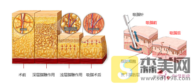 上臂吸脂一般什么价位