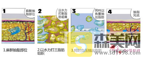 上臂吸脂一般什么价位