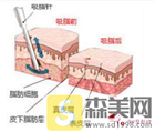 腿吸脂费用