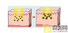 术前科普：激光祛斑多少钱一次？