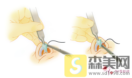 没多少痛感隆鼻术是什么