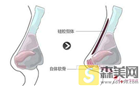 【隆鼻小贴士】硅胶垫鼻梁多久要取出来？