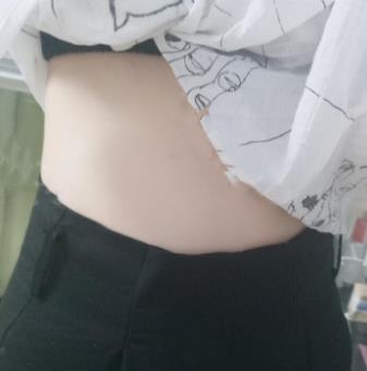 上海艺星整形医院吸脂怎么样？真实瘦腰腹经历，附照片