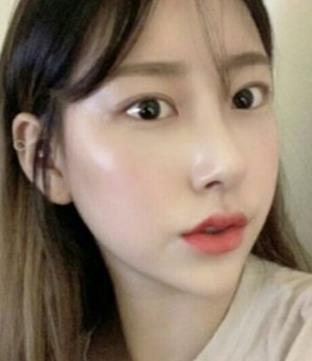 西南医院整形美容科双眼皮案例果分享，从此就是小仙女儿了。