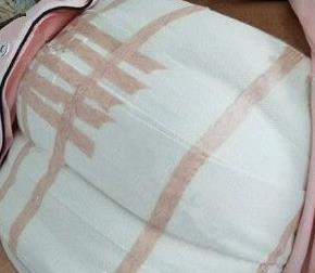 重庆西南医院整形科隆胸案例在线查看，术后有惊喜！