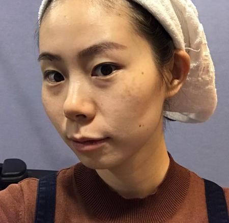 枣庄市立医院整形科去疤痕多少钱？手术果恢复过程一览
