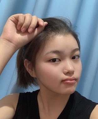 徐州市第一人民医院美容科下颌角磨骨手术果分享，丑小鸭变白天鹅~