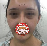 【祛眼袋+自体脂肪填充】烟台鹏爱整形医院减龄一步到位