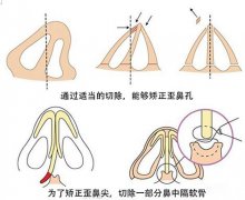 宽鼻梁矫正要多少钱？项目介绍和案例展示