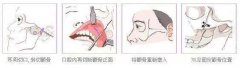 颧弓降低项目介绍,价格是多少？附案例展示