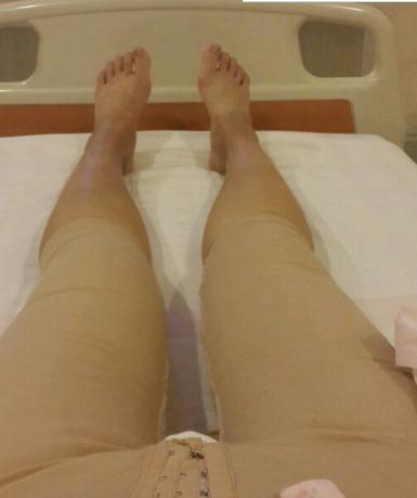 医生给我推荐的大腿吸脂案例后，我也终于下定决心来实现了