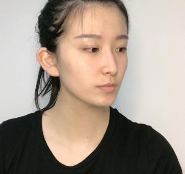 attention！真人出镜的韩式隆鼻前后比较图，不说肯定以为是两个人