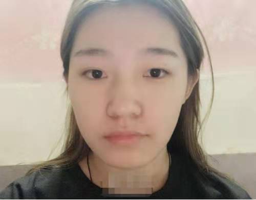 东方和谐二次填充技术如何，亲身体验面部脂肪填充案例分享