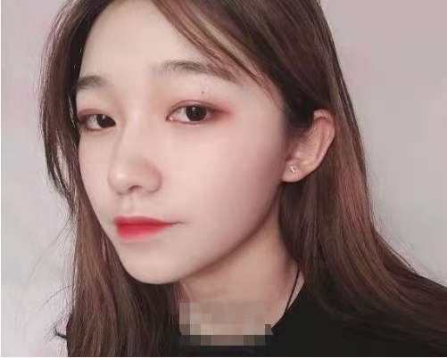 东方和谐二次填充技术如何，亲身体验面部脂肪填充案例分享