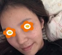 在福州海峡整形美容医院做的激光美肤去斑，真是让我完成了蜕变