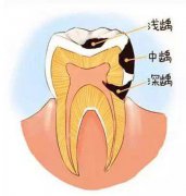 从小不注重口腔卫生，这龋齿可把我害惨了