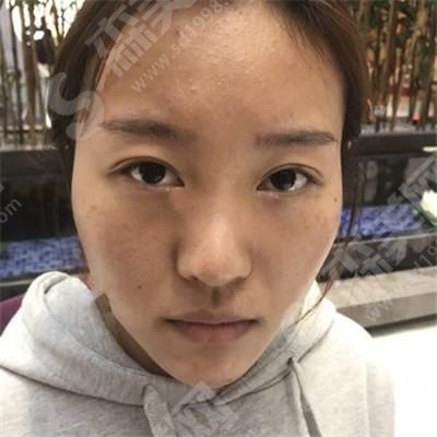 罗汇东医生的隆鼻技术.jpg