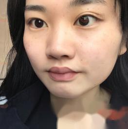 陆华医师的厚唇改薄做得如何?会复发吗?