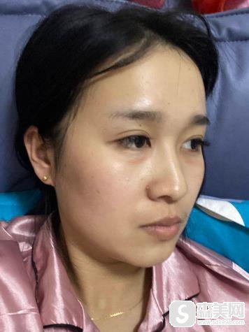 上海去眼袋就选时光！附术后恢复记录