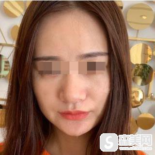 注射瘦脸抗衰老原理？上海九院注射果图对比