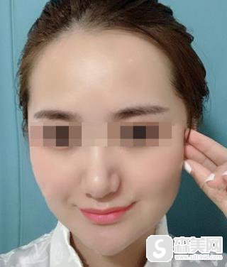 注射瘦脸抗衰老原理？上海九院注射果图对比