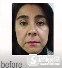 fotona4d溶脂果好吗？fotona4d的科普知识以及作用