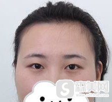 开眼角的明星对比照片让我有了做眼整形的动力/做完后的果真是牛啊!