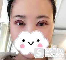 开眼角的明星对比照片让我有了做眼整形的动力/做完后的果真是牛啊!
