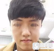 上海九院代杰文医生在正颌领域的学识怎么样?地包天用正颌改变后变得越来越漂亮