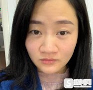 杭州美莱自体软骨隆鼻的果，附真人案例恢复记录