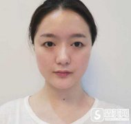 杭州117医院美容科双眼皮修复，附真实案例＋前后照片对比