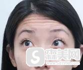 去除抬头纹多少钱？恢复时间需要多久？附去除抬头纹前后果图