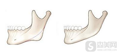 去下颌角是什么？果怎么样？附去下颌角整形案例前后果对比图