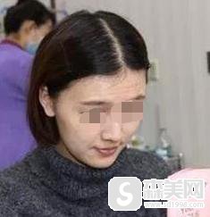 去抬头纹要花多少钱？附玻尿酸填充抬头纹案例分享