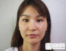 艺星医学美容医院价目表2021，整形医院哪家好？内含双眼皮手术案例