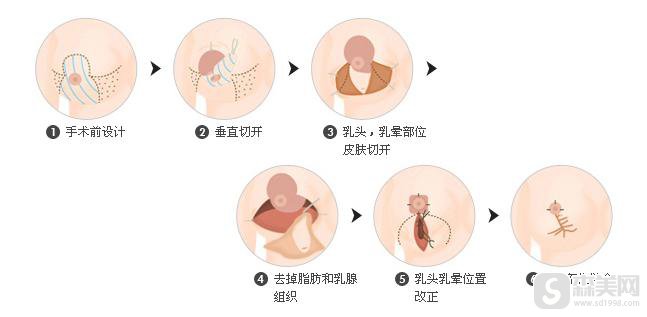 巨乳缩小术果怎么样？附巨乳缩小手术案例分享＋手术前后果对比图