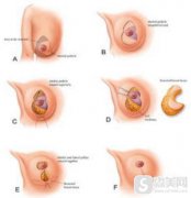 巨乳缩小术果怎么样？附巨乳缩小手术案例分享＋手术前后果对比图