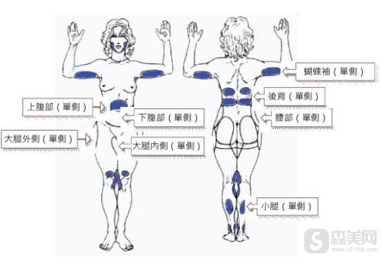 镭射溶脂价格？镭射溶脂果怎么样？镭射溶脂案例前后果对比图