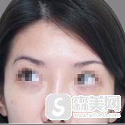 去抬头纹要多少钱？附去抬头纹案例+真人案例前后对比图