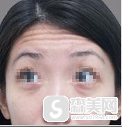 去抬头纹要多少钱？附去抬头纹案例+真人案例前后对比图