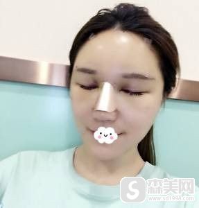 天津维美整形医院的隆鼻果，让我成功地脱离了塌鼻，果很好,案例分享