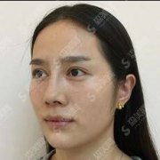 上海正规整形医院价目表2021/打美白的术后功/美莱整形医院注射案例对比图