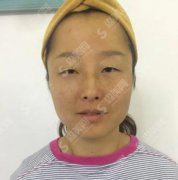 北京丽都医疗美容医院价目表2021，激光去眼袋多少钱？内含激光去眼袋案例