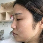 注射整形价目表2020伊婉玻尿酸天填充的果？内附玻尿酸面部填充的恢复过程图