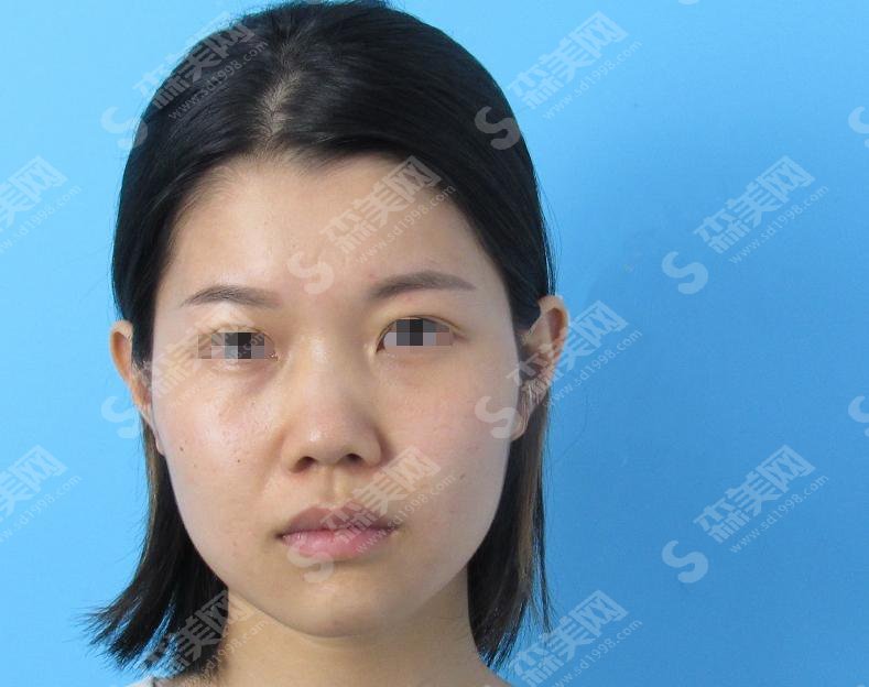 整形专家彭喆怎么样？彭喆医师做的隆鼻果怎么样？附医院介绍及彭喆医师案例分享