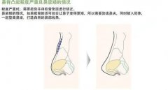 驼峰鼻矫正的费用？附驼峰鼻案例+前后果对比图