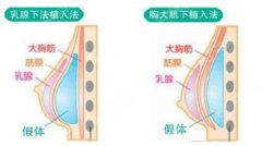 隆胸的价格？附隆胸案例+前后果对比图