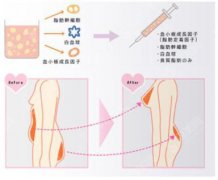 注射隆胸的价格？附注射隆胸案例+前后果对比图