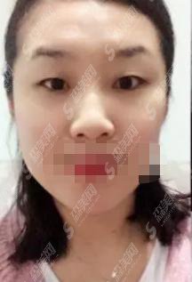 宁波二院整形美容科怎么样？该院做的双眼皮果怎么样？附宁波二院整形科医师介绍及案例分享